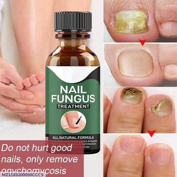 Hypoallergenic Nail Fungus Treatment Serum - 1 Pc for Effective Health