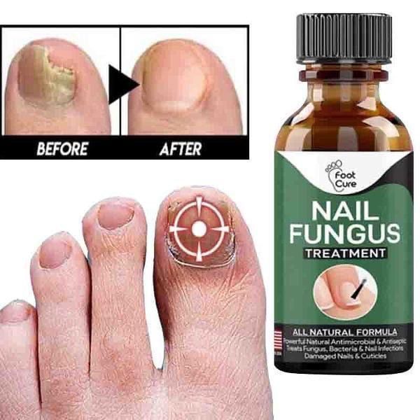Hypoallergenic Nail Fungus Treatment Serum - 1 Pc for Effective Health
